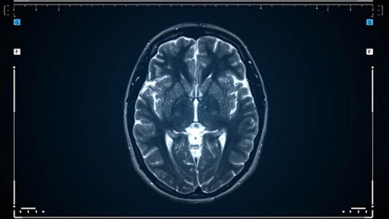 Immagine di una scansione cerebrale MRI che mostra una sezione trasversale del cervello umano, evidenziata su sfondo scuro con dettagli chiari delle strutture cerebrali.